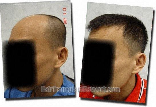 Hair restoration procedure results