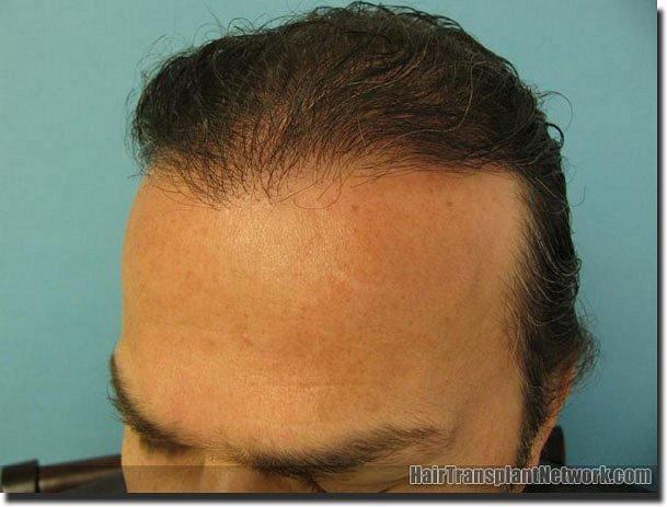 Hair restoration procedure results