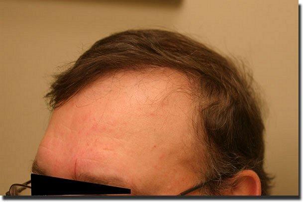 Hair restoration procedure results