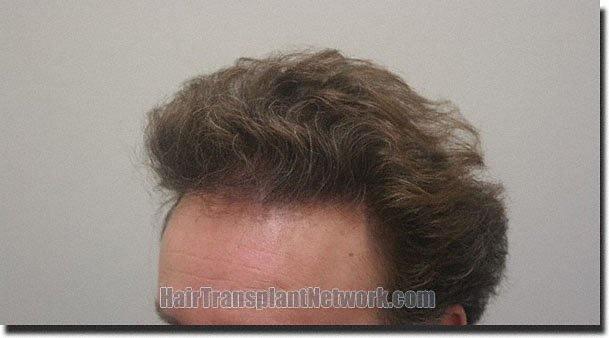 Hair restoration procedure results