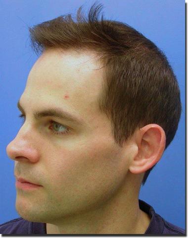 Hair restoration procedure results