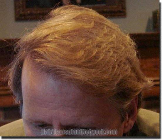 Hair restoration procedure results