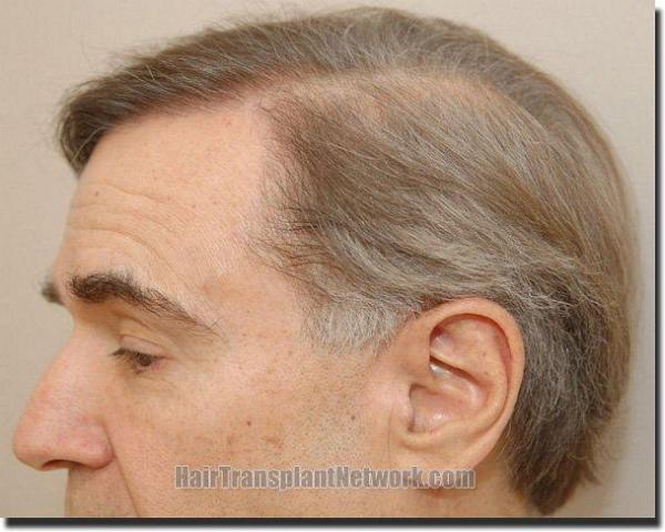 Hair restoration procedure results