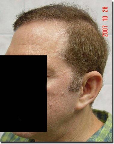 Hair restoration procedure results