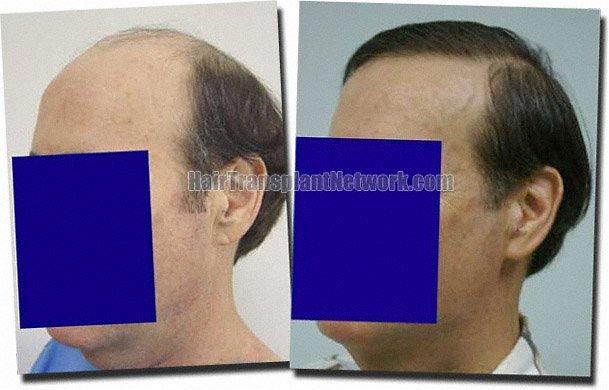 Hair restoration procedure results