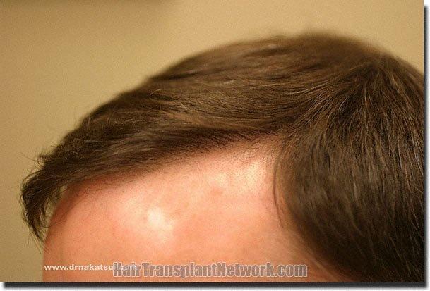 Hair restoration procedure results