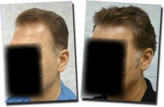 Hair restoration procedure results