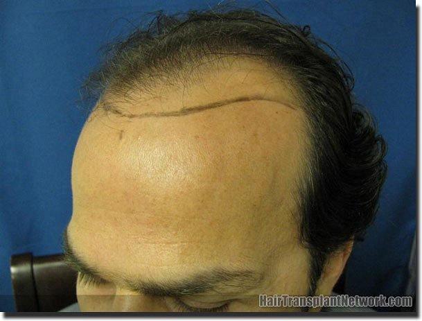 Hair restoration procedure results