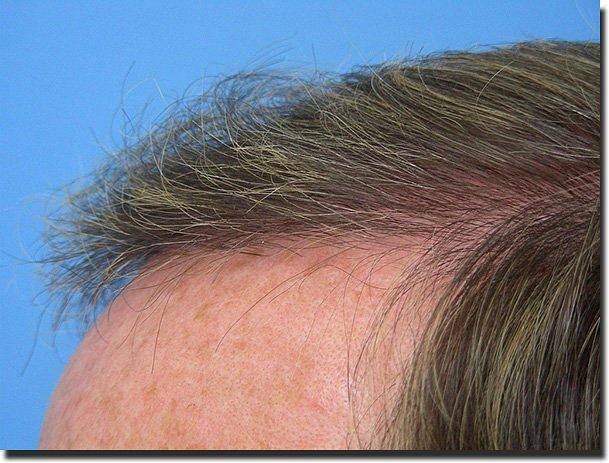 Hair restoration procedure results