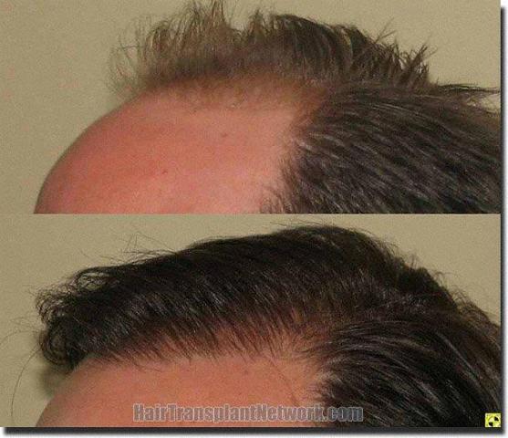 Hair restoration procedure results