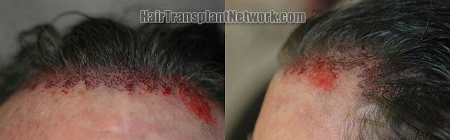 Surgial detail of the hair transplant