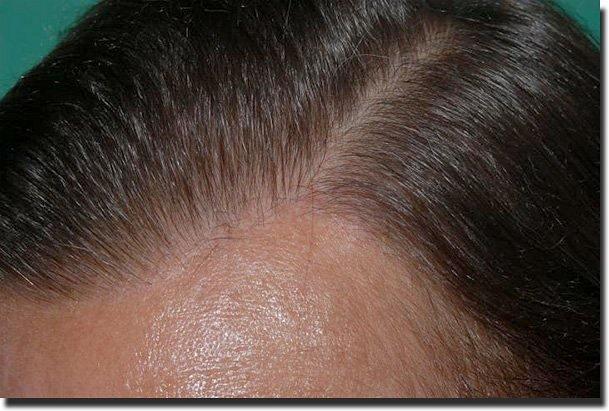 Hair restoration procedure results