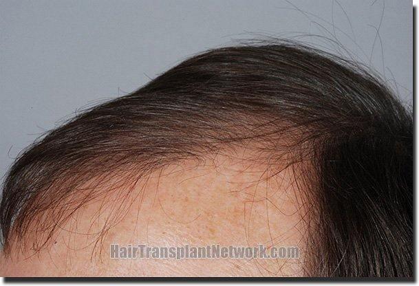 Hair restoration procedure results