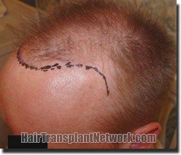 Hair restoration procedure results