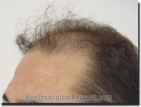 Hair restoration procedure results