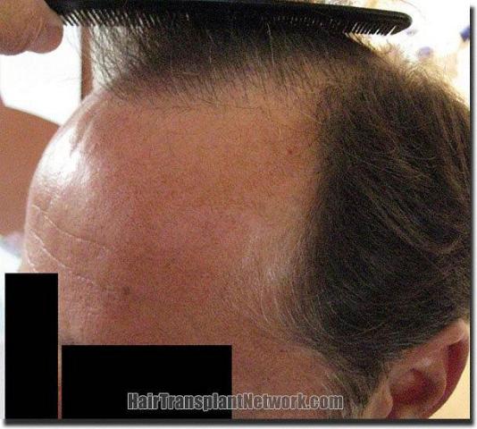 Hair restoration procedure results