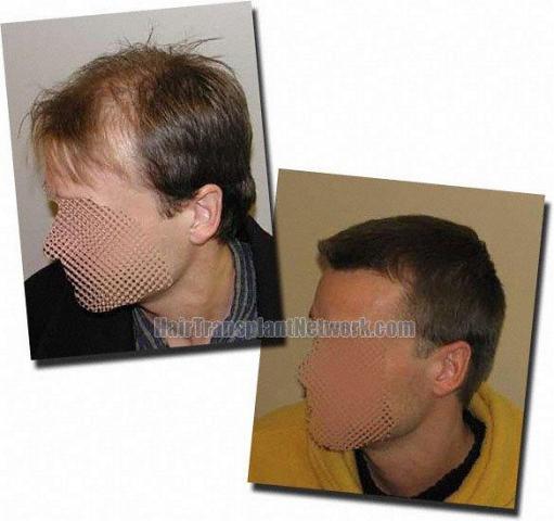 Hair restoration procedure results