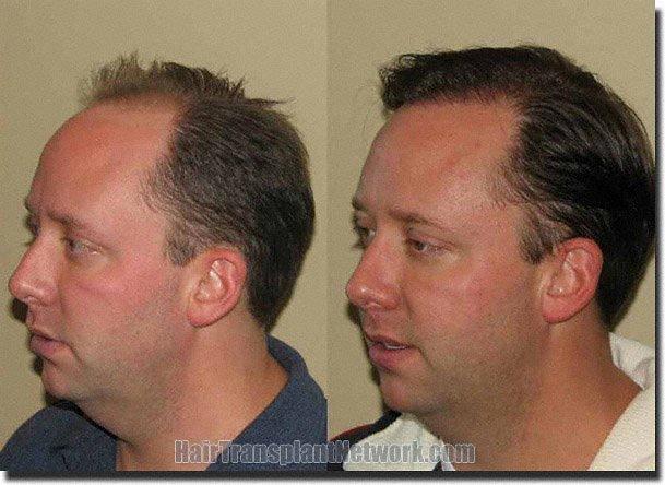 Hair restoration procedure results