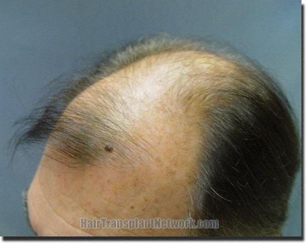 Hair restoration procedure results