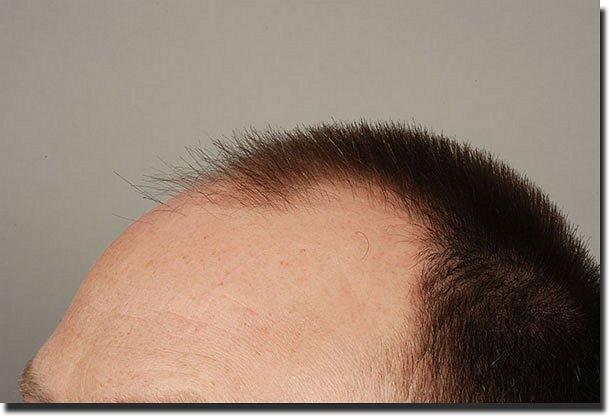 Hair restoration procedure results