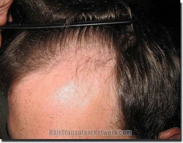 Hair restoration procedure results