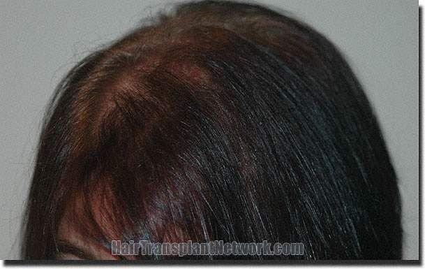 Hair restoration procedure results