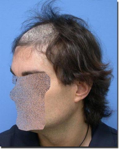 Hair restoration procedure results