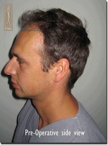 Hair restoration procedure results