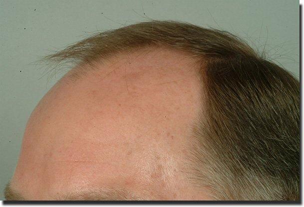 Hair restoration procedure results