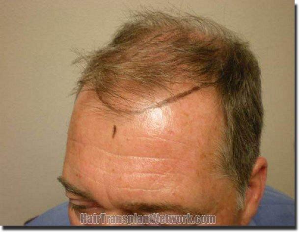 Hair restoration procedure results