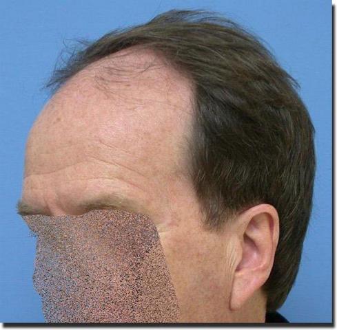 Hair restoration procedure results