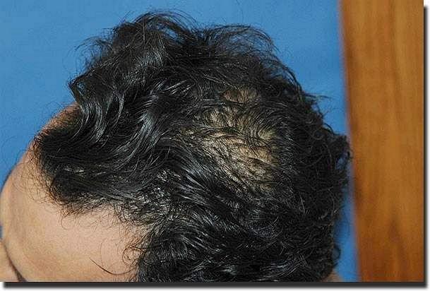 Hair restoration procedure results