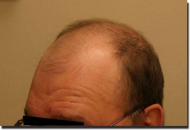 Hair restoration procedure results