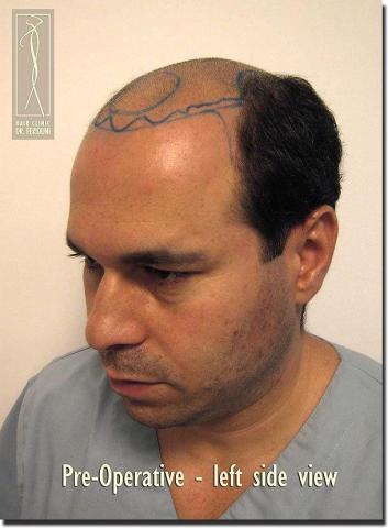 Hair restoration procedure results