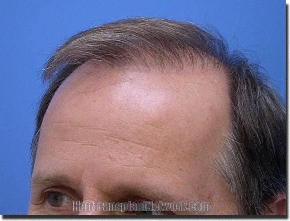 Hair restoration procedure results