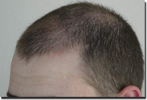 Hair restoration procedure results