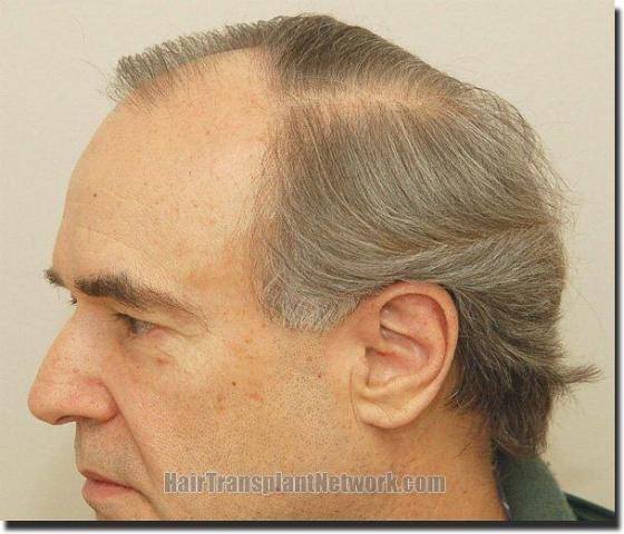 Hair restoration procedure results