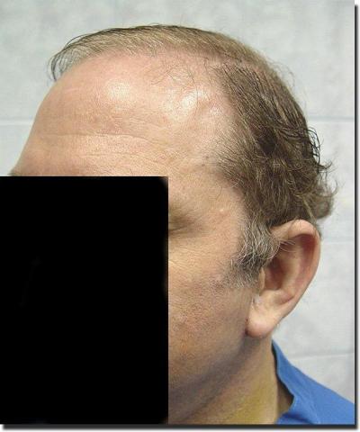 Hair restoration procedure results