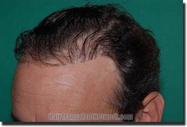 Hair restoration procedure results