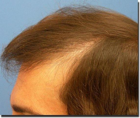 Hair restoration procedure results