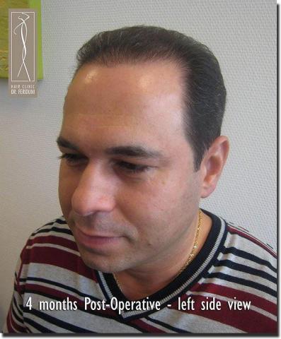 Hair restoration procedure results