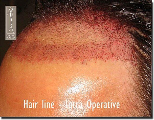 Hair restoration procedure results