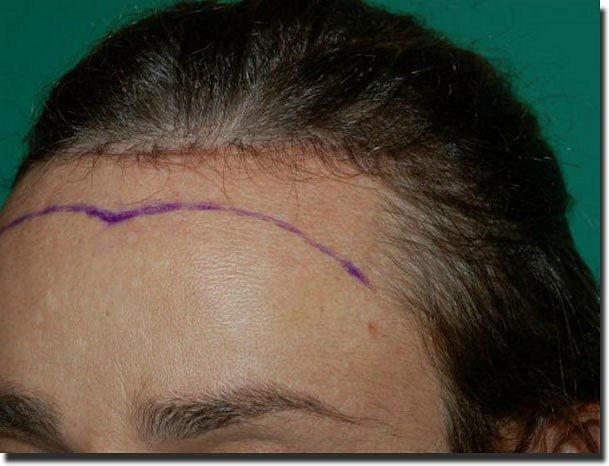 Hair restoration procedure results