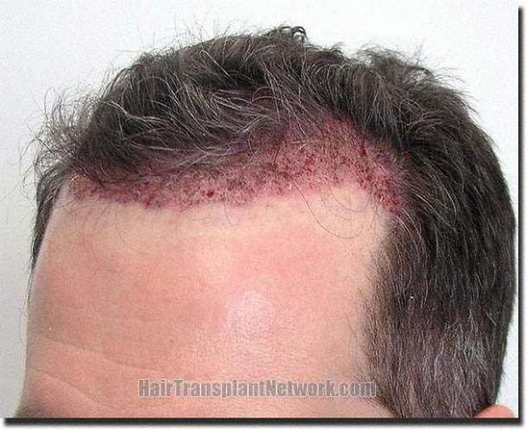 Hair restoration procedure results