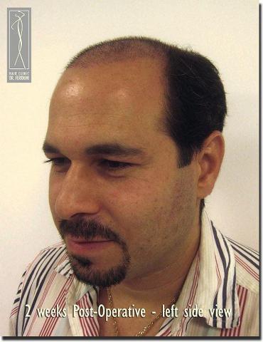 Hair restoration procedure results