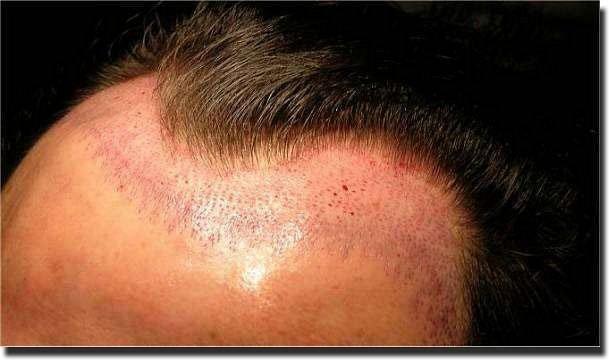 Hair restoration procedure results