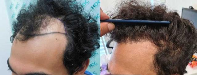 Left side of patient, before and after hair transplant