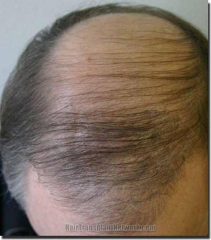 What is Direct Hair Implantation DHI  Hair Transplant Network