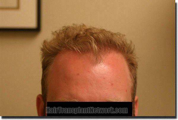 Hair restoration procedure results