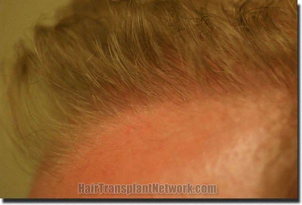 Hair restoration procedure results